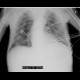 Skin folds, mimic of pneumothorax, PNO: X-ray - Plain radiograph